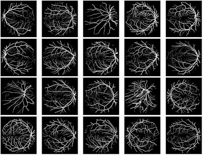 Difference of anisotropic and isotropic TV for segmentation under blur and Poisson noise